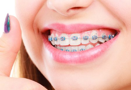 تعرف على أبرز أنواع تقويم الأسنان وأيهم يناسبك
