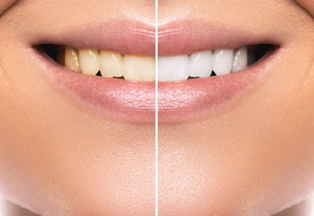 طرق متعددة وتقنيات مختلفة لعمل تبييض الأسنان في تركيا